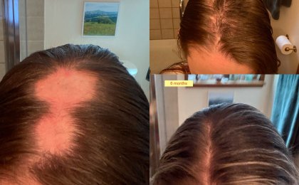 Before and after hair regrowth results showing natural hair loss for women – 6-month progress