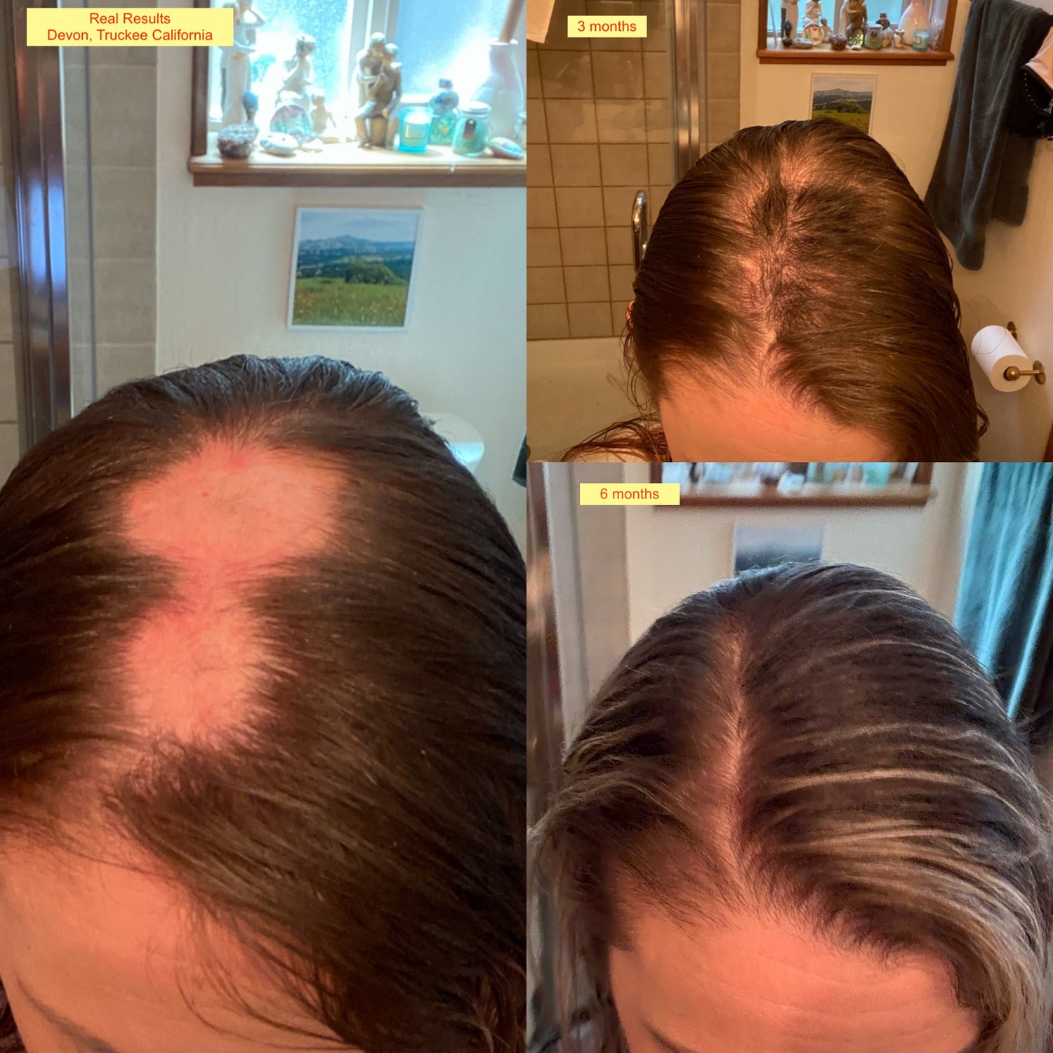 Struggling with Hair Loss? It’s Not Just About Biotin. Natural hair loss treatment